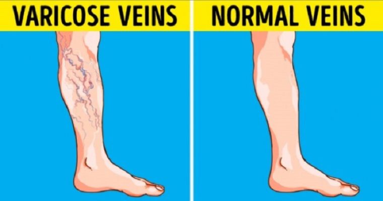 How to Prevent Reverse Varicose Veins Permanently?