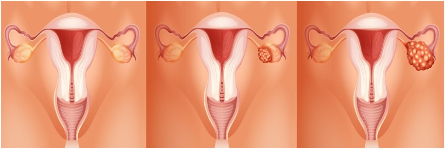 Ovarian Cancer