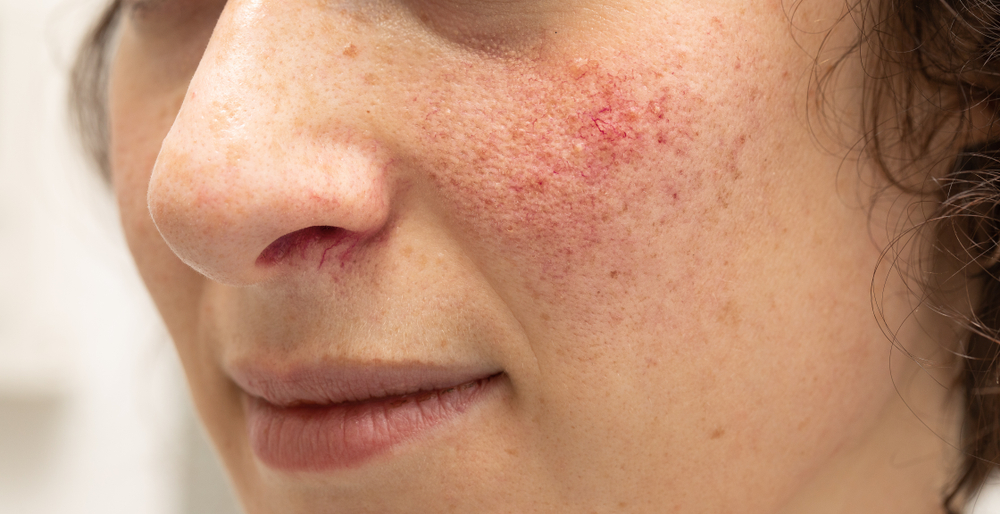 Rosacea