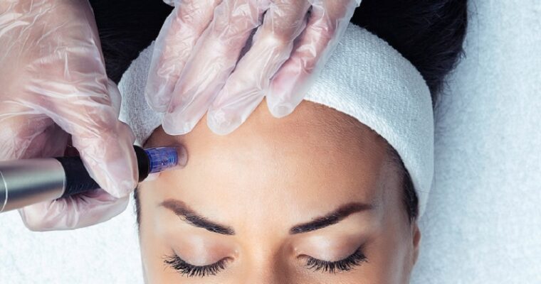 Everything You Need to Know About Skin Needling