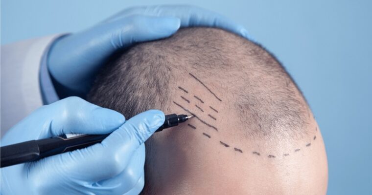 What to Look for When Selecting the Best Hair Transplant Clinic?