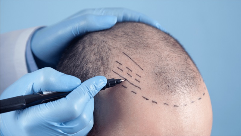 What to Look for When Selecting the Best Hair Transplant Clinic?